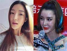 整容填充明星前后对比照